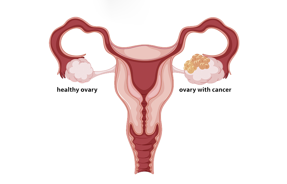 Ovarian cancer playa del carmen.jpg